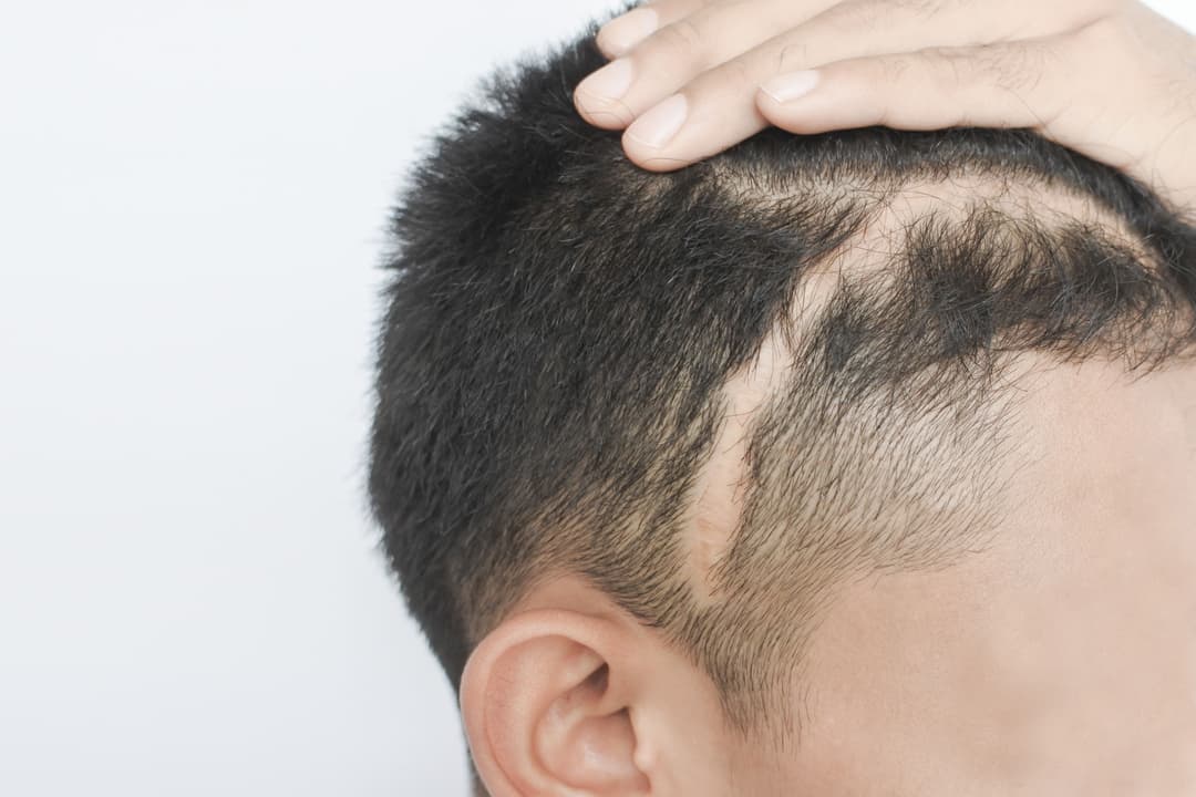 Scar Removal