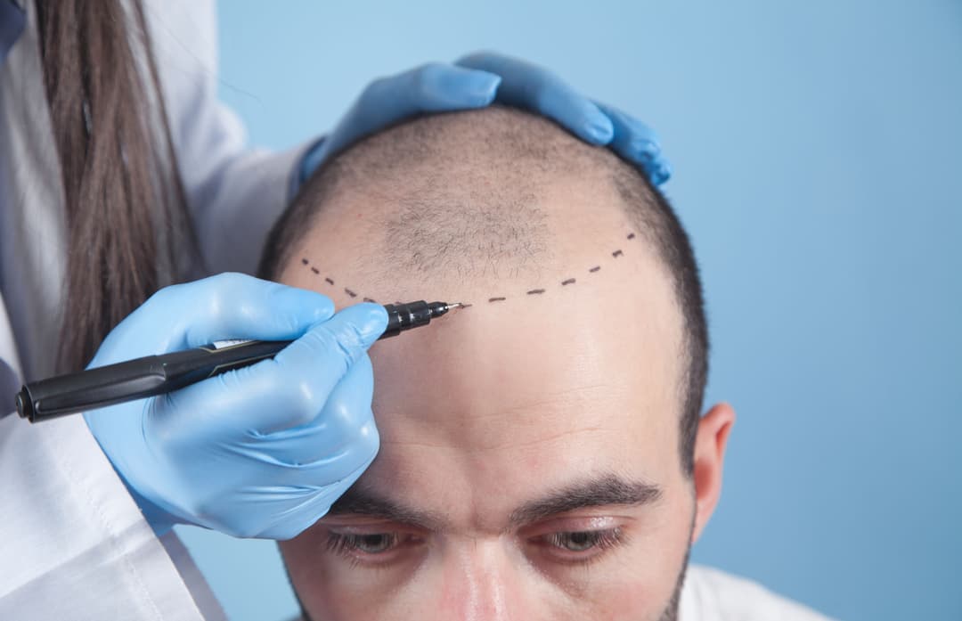 Hair Transplant Results: Healing Process and Key Details