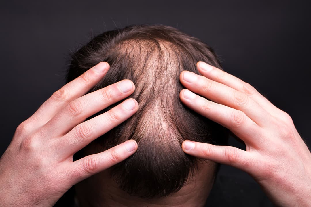 Hair Loss in Men