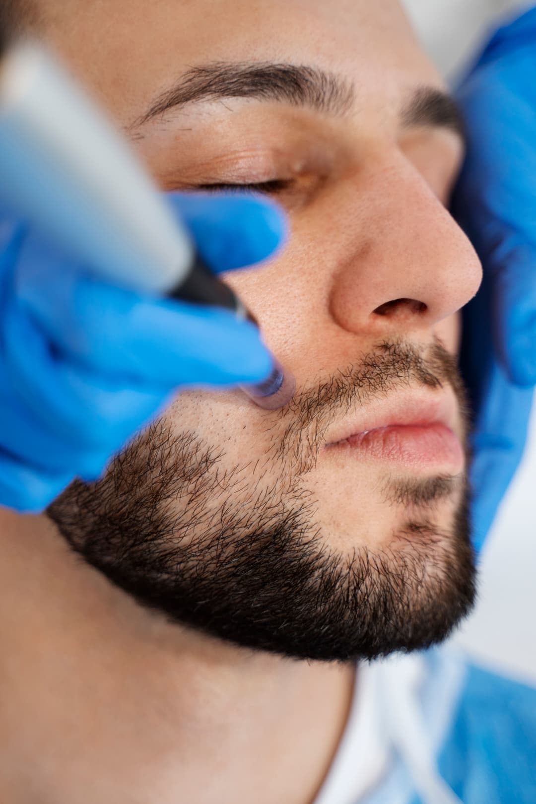 Beard / Mustache Transplantation